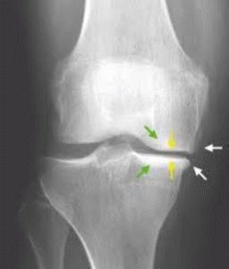Гонартроза на колянната става от трета степен