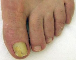 Как да се справим с гъбичките на ноктите на краката
