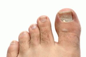 Как да се третира гъбата на ноктите на краката с йод