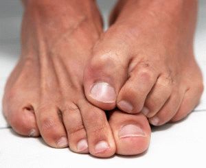 Как да се третира гъбата на ноктите на краката с оцет