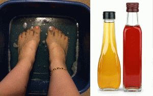 Как да се третира гъбата на ноктите на краката с оцет