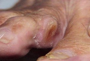 Възпаление на калуса на пръста