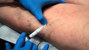 Инжекции от варикозни вени по краката