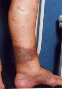 Инжекции от варикозни вени по краката