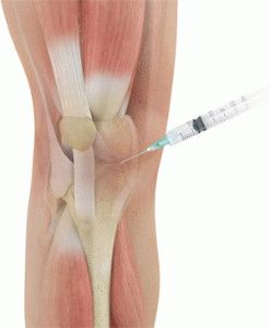 Инжекции в колянната става с артроза