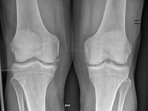 Възможно ли е да се излекува артрозата на колянната става