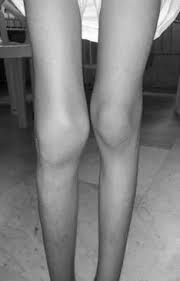 Хемартроза на колянната става
