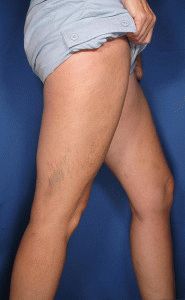 Мехлеми от васкуларните кълнове на краката