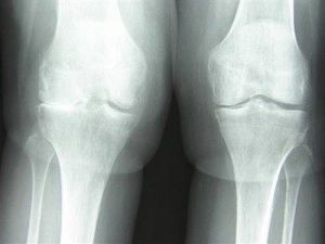 Остеоартрит на колянната става от 1 градус