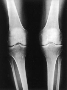 Остеоартрит на колянната става от 2 градуса