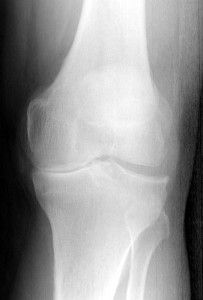 Остеоартрит на колянната става от 4-та степен