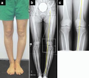 Остеоартрит на колянната става от трета степен