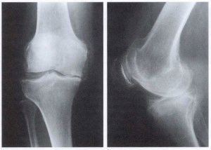 Остеоартрит на колянната става от трета степен