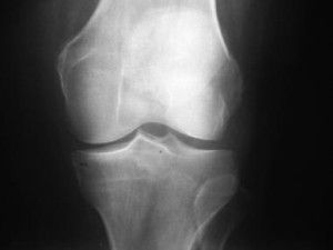 Остеоартрит на колянната става от втора степен
