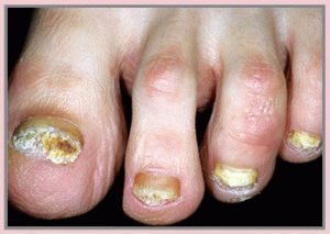 Пероксид от гъбички на ноктите на краката