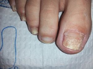 По-чисти от гъбички на ноктите на краката