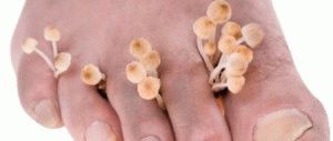 Отстраняване на ноктите на крака с гъбички