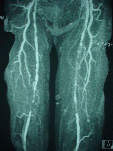 Стенозираната артериосклероза на артериите на долните крайници