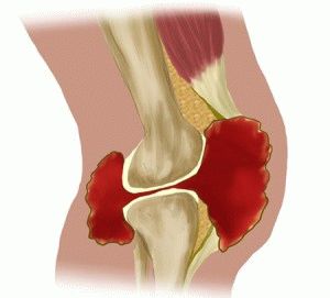 Симптомите на артрозата на колянната става