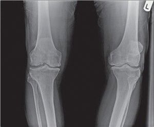 Симптомите на артрозата на колянната става