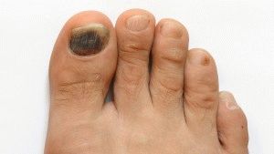 Симптомите на гъбичките на ноктите на краката
