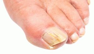 Симптомите на гъбичките на ноктите на краката