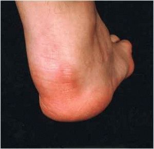 Симптоми на псориатичен артрит
