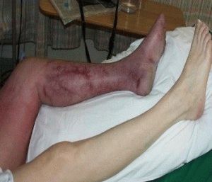 Симптоми на тромбофлебит на долните крайници
