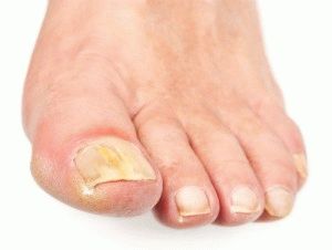 Причини за гъбички на краката