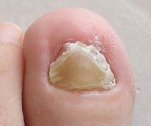 Лечение на хронични гъбички на ноктите на краката