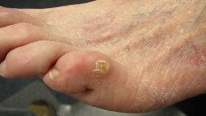 Лечение на сухи мазоли на краката с народни средства