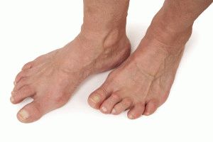 Лечение на артрит на краката у дома