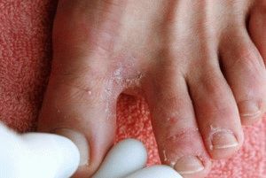 Лечение на гъбички между пръстите на краката