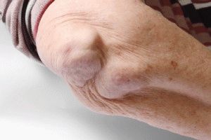 Лечение на ревматоиден артрит с акупунктура