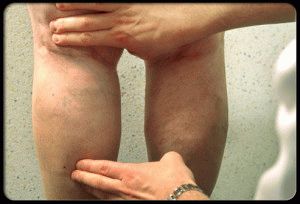 Лечение на разширени вени по краката