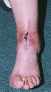 Лечение с трофични язви на крака с мехлеми