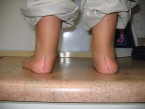Видове плоски крака при деца