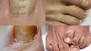 Видове гъбички на ноктите на краката