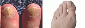 Видове гъбички на ноктите на краката