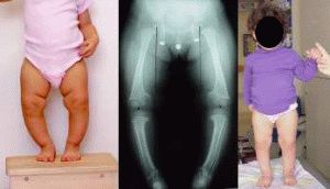 Valgus кривина на краката при дете