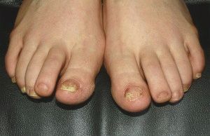 Лак за лечение на гъбички на ноктите на краката