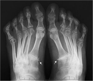 Рентгенови признаци на ревматоиден артрит