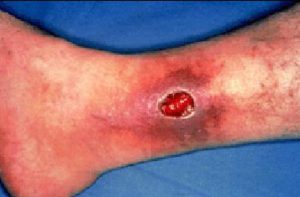 Предотвратяване на трофични язви по краката