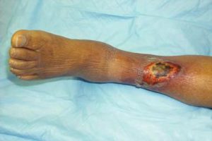 Лечение на трофични язви на крака у дома