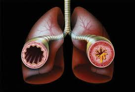 Бронхиална астма. Причини, симптоми, съвременна диагностика и ефективно лечение