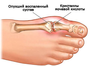 Артрит на пръстите на ръцете - как и какво да лекува болестта?