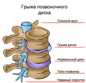 Как и какво да лекува херния на лумбосакралния гръбначен стълб?
