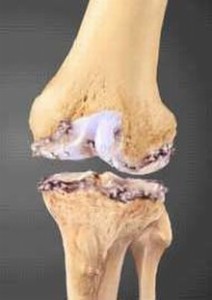 Колко правилно да се третира артрозата на колянната става?