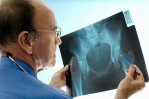 Как да се лекува остеопороза на тазобедрената става - един от най-страшните видове остеопороза