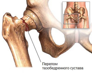 Как да се лекува остеопороза на тазобедрената става - един от най-страшните видове остеопороза